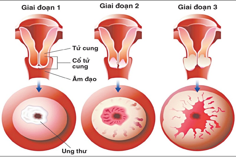 Minh họa ung thư cổ tử cung các giai đoạn 1 - 2 - 3