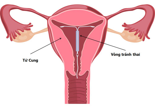 Minh họa vị trí đặt vòng tránh thai tCu
