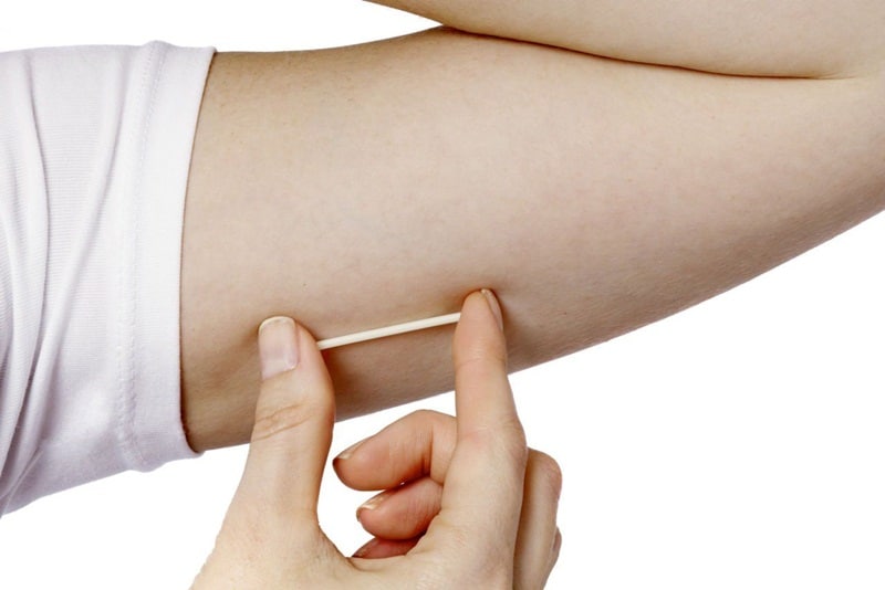Que tránh thai được cấy vào dưới da tay của người phụ nữ