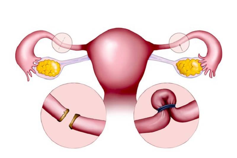 Thắt hoặc cắt ống dẫn trứng là phương pháp tránh thai vĩnh viễn ở người phụ nữ