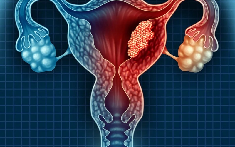Ung thư cổ tử cung đe dọa tới tính mạng của hàng triệu phụ nữ trên thế giới