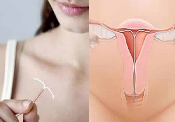Có nhiều dấu hiệu nhận biết khi tuột vòng tránh thai bạn nên biết