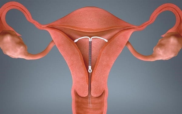 Kỹ thuật đặt vòng tránh thai chi tiết