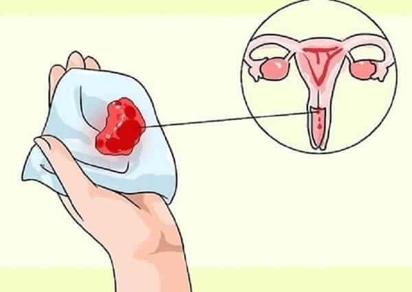 Liên tục bị chảy máu sau khi đặt vòng là một trong những dấu hiệu nên tháo vòng tránh thai