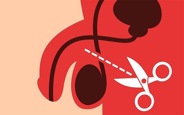 Phương pháp thắt ống dẫn tinh dành cho nam để ngừa thai