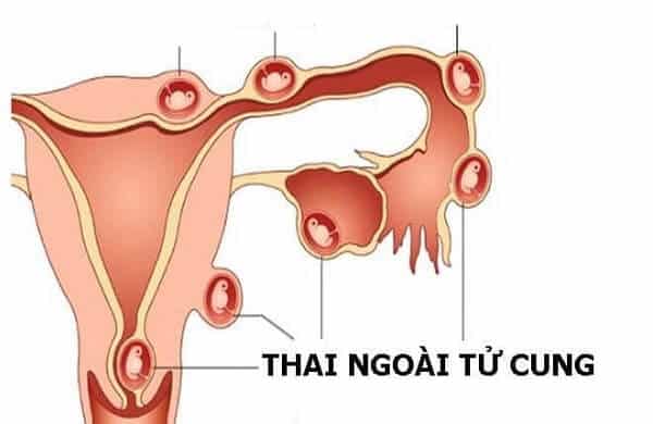 Thai ngoài tử cung là một câu trả lời hiếm gặp
