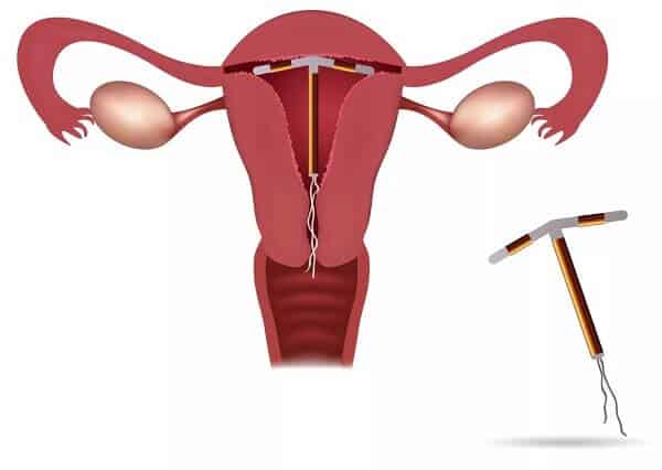 Vòng tránh thai tác động niêm mạc tử cung tạo tác dụng tránh thai