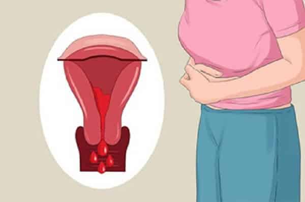 Cấy que tránh thai có thể gây rong kinh