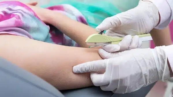 Quy trình cấy que tránh thai vào cơ thể