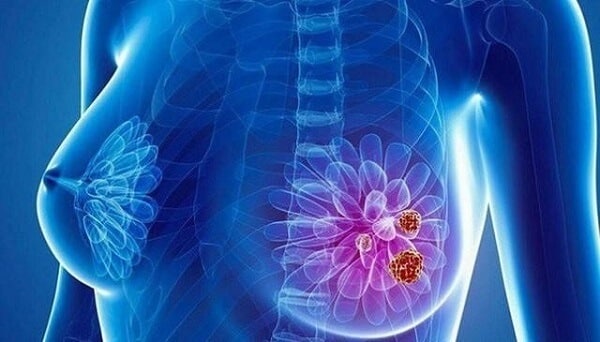 Ung thư vú là một trong những tác hại của thuốc tránh thai khẩn cấp